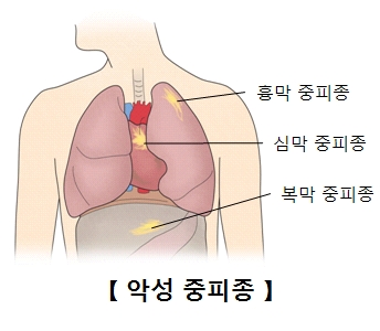 흉막 중피종 심막 중피종 복막 중피종 위치를 나타낸 예시