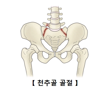 천추골 골절의 사진 예시