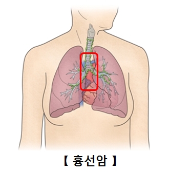 흉선암의 대한 예시