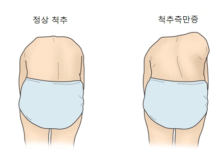 허리를숙였을때 정상척추와 척추측만증 사진예시