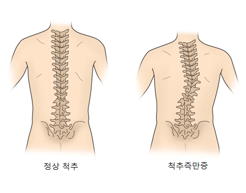 정상척추와 척추측만증 사진 예시