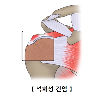 건 조직에 석회가 침착된 사진 예시