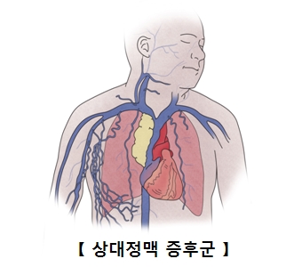 상대정맥 증후군의 예시