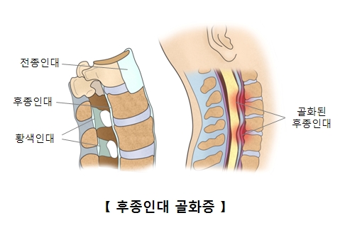 전종인대 후종인대 황색인대의 위치와 골화된후종인대 사진예시