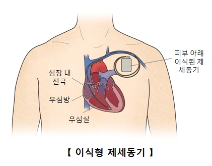 심장 내 전극 우심방 우심실 피부아래 이식된 제세동기의 위치및 이식형 제세동기의 예시