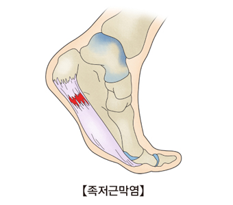 족저근막의 위치