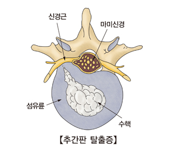 추간판탈출증및 신경근,마미신경,섬유륜,수핵의 위치