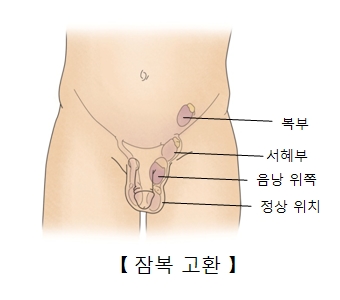 복부  서혜부 음낭위쪽 정상위치 등 잠복고환의 예시