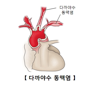 다까야수 동맥염의 예시