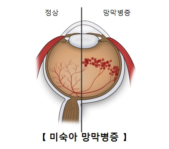 미숙아의 정상적인 망막과 망막병증에걸린 사진 예시