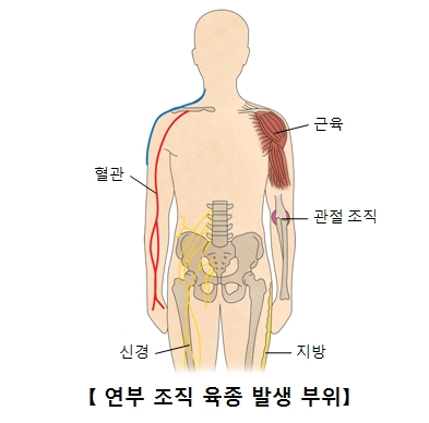 연부조직육종발생부위 및 혈관,근육,관절조직,신경,지방의 위치