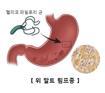 위장속 헬리코 파일로리 균으로 인해 위 말트 림프종이 발생한 예시