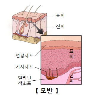 표피 진피 편평세포 기저세포 멜라닌색소포로 이루워진 모반의 구성 예시