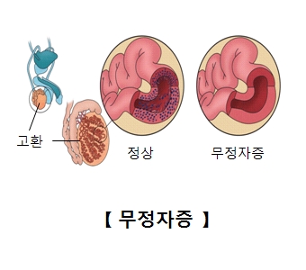 고환의 정상적인 상태와 무정자증의 상태의 비교예시