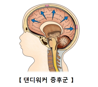 댄디워커 증후군 그림 예시