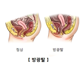 정상적인 방광 및 방광탈의 예시 