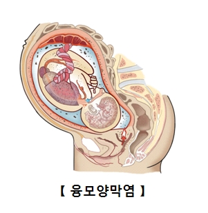 융모양막염-임산부의 융모와 양막에 염증이 생긴 그림 예시