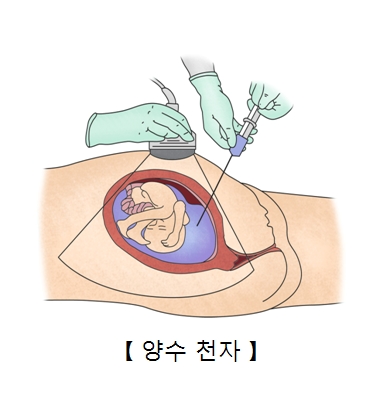 양수 천자 검사를 하고 있는 그림 예시