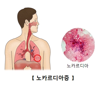 폐에감염된 노카르디아 세포의 모습