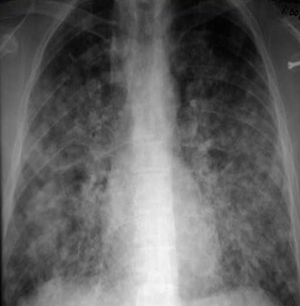 히스토플라즈마증에 감염된 흉부쪽X-ray