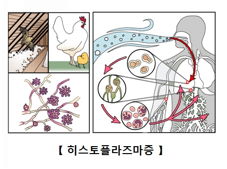 히스토플라스마 세포의 모습과 먹이사슬 관계도에 따라 인간이 감염되어 폐 뿐만이 아니라 혈관을타고 다른기관에 감염된 사진예시