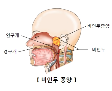 비인두종양의사진예시와 연구개,경구개,비인두의 위치