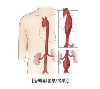 동맥류(흉부/복부) 그림 예시