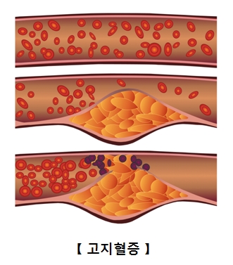 고지혈증 생성 과정 그림 예시