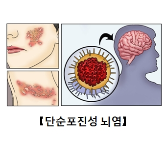 얼굴과목에 단순포진성 뇌염이 발병된모습과 뇌안에 있는 세포의모습