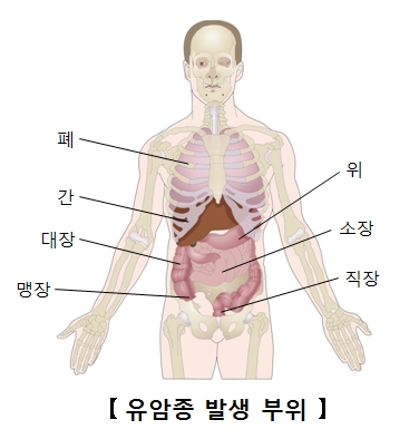 폐 간 대장 맹장 위 소장 직장등 유암종 발생 부위 예시