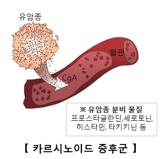 혈관 안 유암종 분비물질로 프로스타글라딘 세로토닌 히스타민 타키키닌등 카르시노이드 증후군의 예시