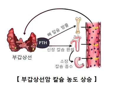 부갑상선의 호르몬이 증가되면서 뼈 칼슘방출 신장 칼슘 환원 소장 칼슘 흡수등 부갑상선암 칼슘농도 상승의 예시