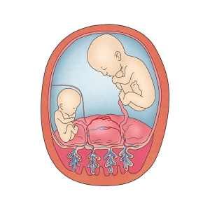 쌍태아 수혈 증후군의 그림 예시