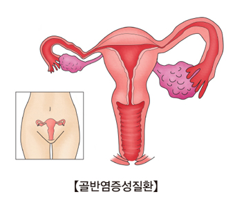 여성의자궁과 골반염증성질환에걸린 질의 모습