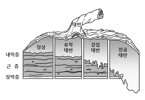 태반안의 내막층 근층 장막층의 모습및 정상,유착태반,감임태반,청공태반일때의 그림 예시