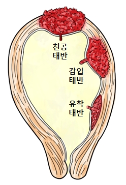 자궁안의 천공태반,감입태만,유착태반의 위치