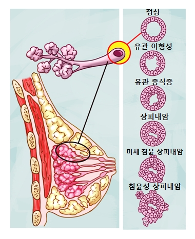 신경종의 정상단면 유관이형성단면 유관증식증단면 상피내암단면 미세침윤상피내암단면 침윤성상피내암단면