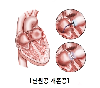 난원공이폐쇄되지않고 개방된 심장의단면도