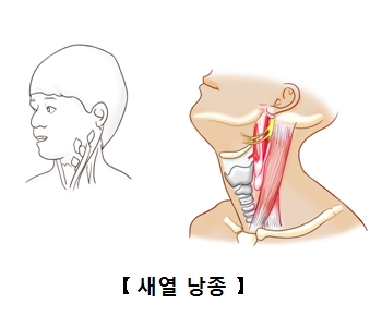 목의옆쪽에 발생된 주모니모양의 혹과누공형태의 낭종