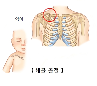 영아의 쇄골모습