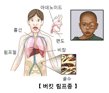 아데노이드 편도 흉선 림프젤 비장 골수의위치와 버킷림프종에감염되한쪽눈이 부운듯하얼굴을한아이의모습