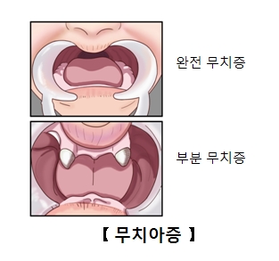 완전무치증과부분무치증 그림 예시