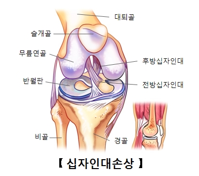 십자인대의구조 슬개골,무릎연골,반월판,비골,경골,전방십자인대,후방십자인대위 위치