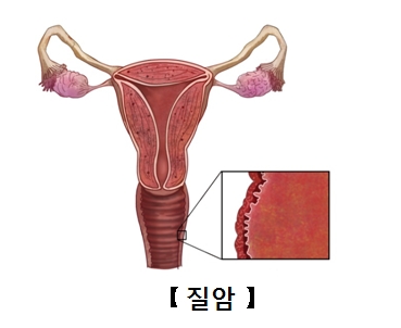 암이발병된질안의 표층모양