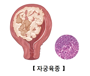 자궁안에발경한육종과세포도말사진