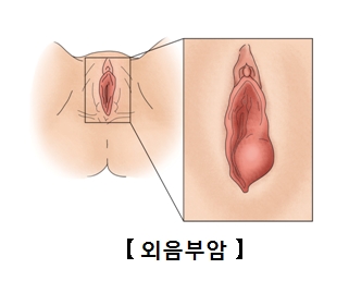 외음부암-여성의 생식기계 입구