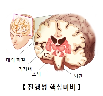 진행성 핵상마비-대외피질,기저핵,소뇌,뇌간 위치