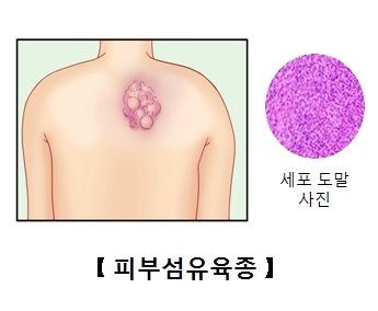 등에발병된피부섬유육종과세포도말사진