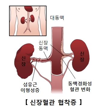 신장동맥변화중 섬유근이형성증과동맥경화성혈관변화