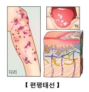 피부와혀에원인모를염증이발생되었음